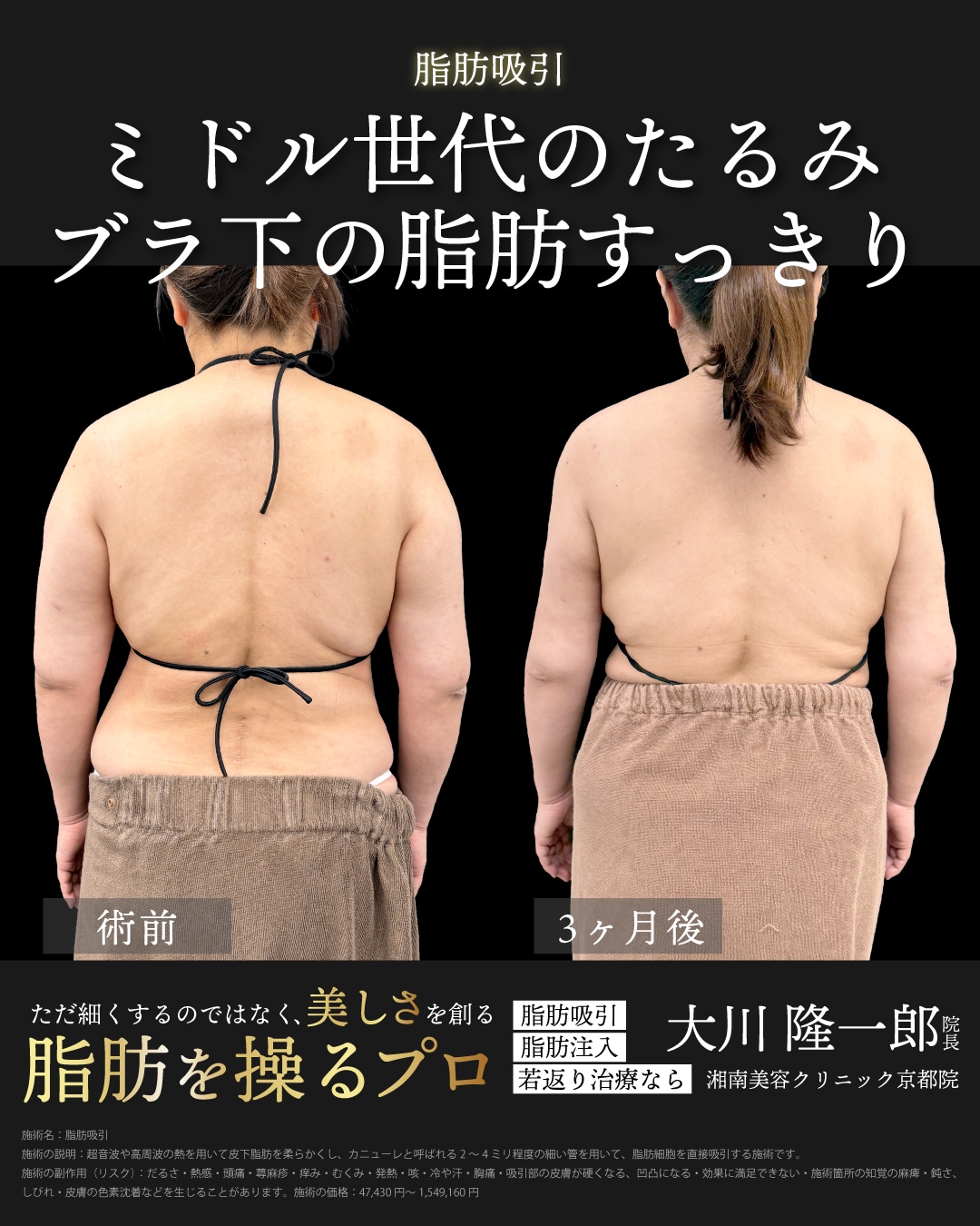 アキーセル脂肪吸引(二の腕全周＋上背部)＋ベイザー併用の症例