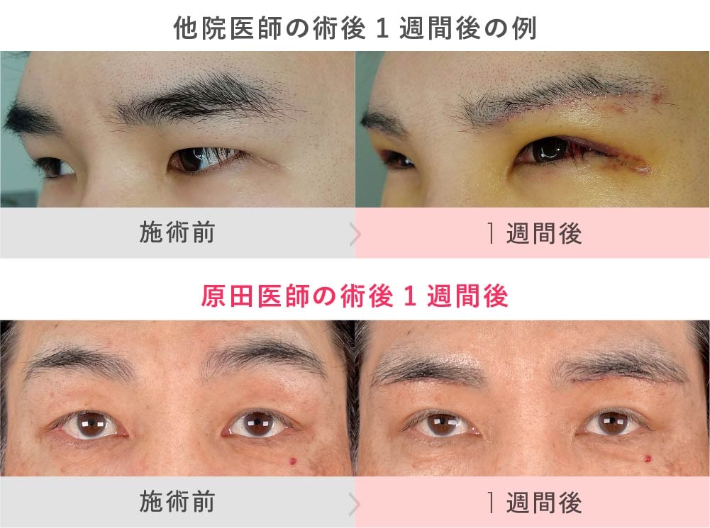 メイクで隠せない男性だからこそ腫れない技術が必須