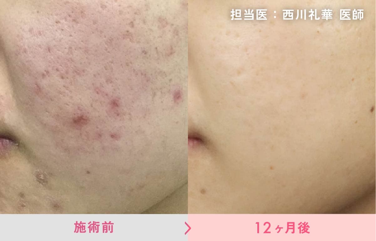 サリチル酸マクロゴール併用治療の症例画像