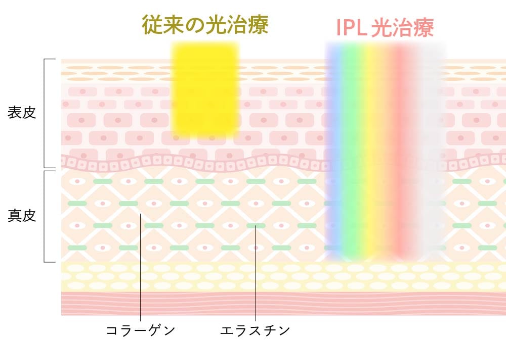 真皮への肌育(光治療版)で叶える、次世代の若返り
