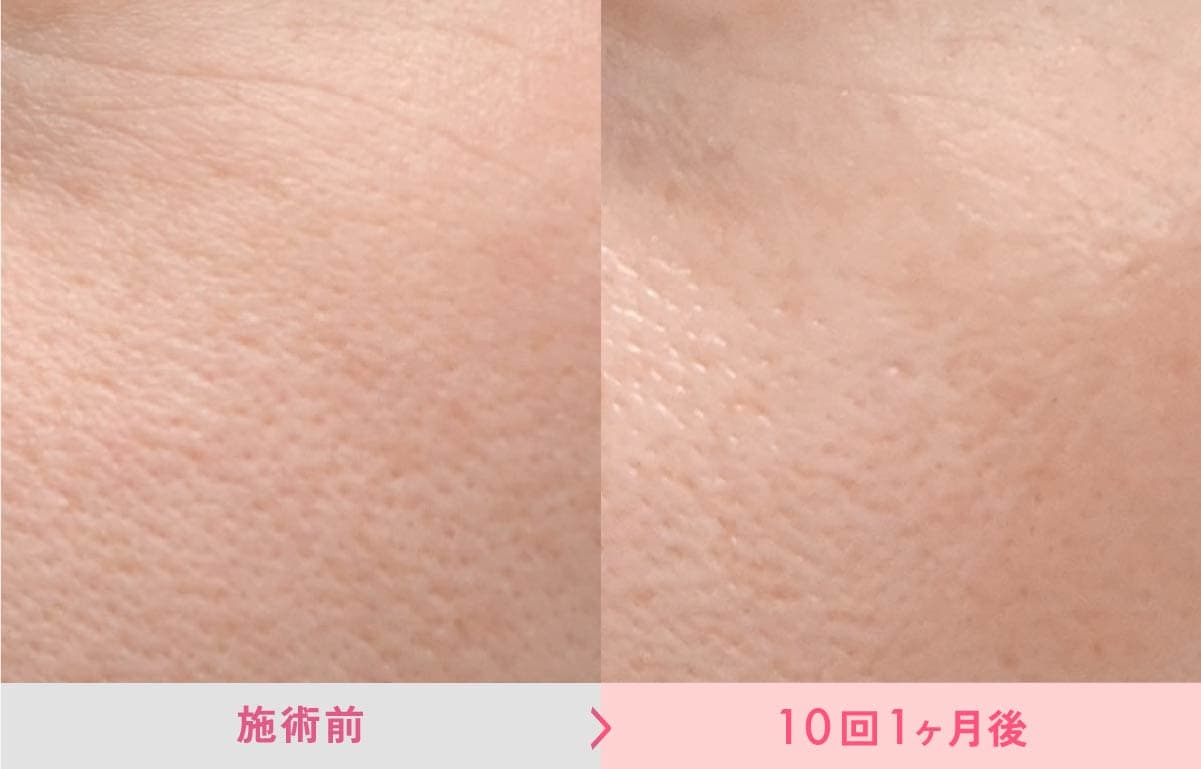 ブラックピールの症例画像