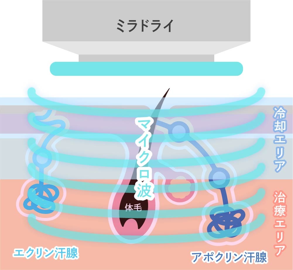 ミラドライの仕組み(マイクロ波による汗腺の熱破壊と冷却システム)