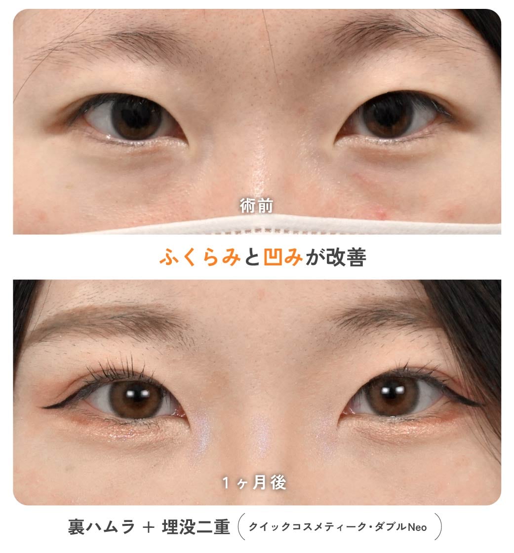 SBC京都院 20代女性の裏ハムラ法+二重埋没法の同時施術症例(術前・術後)