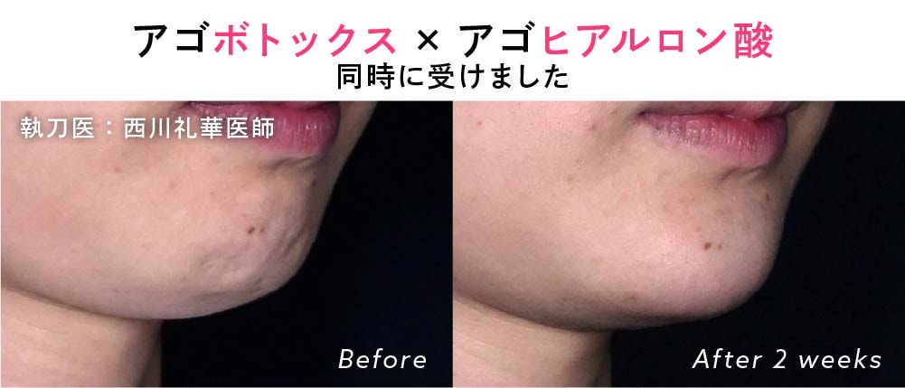 京都院 アゴのヒアルロン酸・ボトックス併用治療 症例