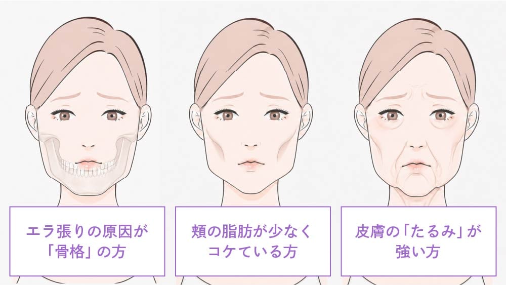 京都院が解説するエラボトックスをしない方がいい人・向いていない人の特徴