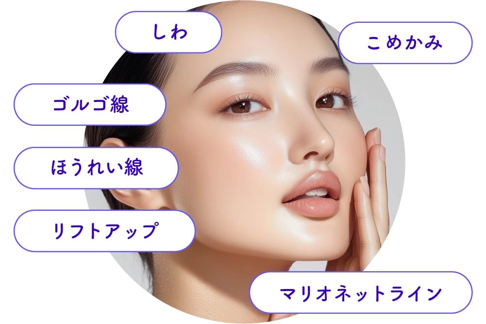 京都でほうれい線やマリオネットラインの深いシワ・凹みをヒアルロン酸注射で改善し若返り