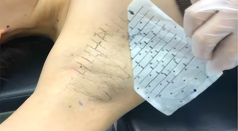 ミラドライ施術手順 Step2:テンプレートを使用した正確な発汗部位マーキング