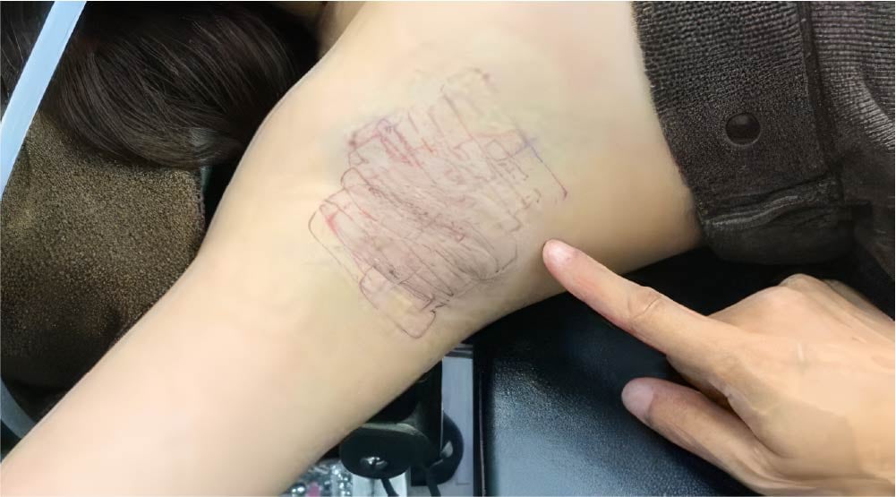 ミラドライ施術手順 Step4:施術直後のワキの確実な冷却と鎮静ケア