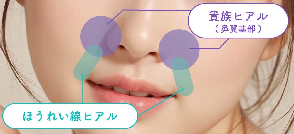 ほうれい線と貴族フィラーの注入部位の違い
