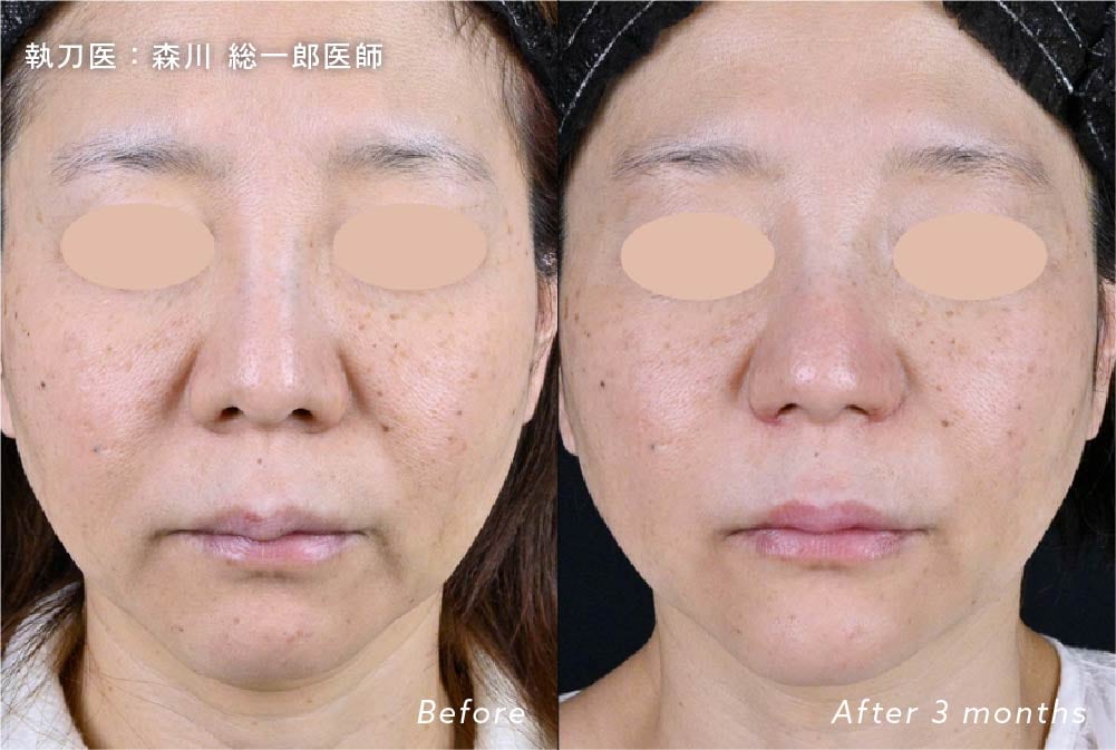京都院のプロファイロ(次世代ヒアルロン酸)とヒアルロン酸併用によるシワ・たるみ改善症例