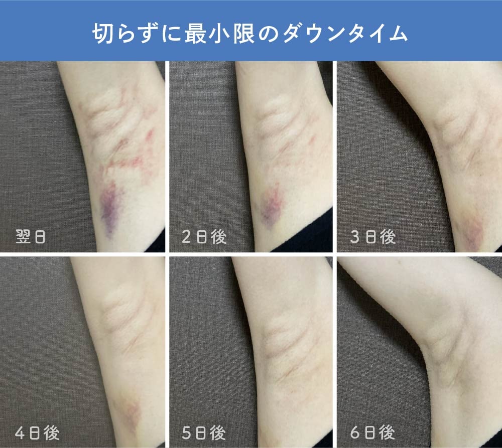 ミラドライ施術後のリアルなダウンタイム経過(腫れ・内出血の目安)