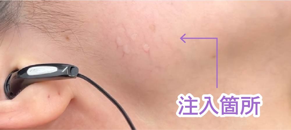 エラボトックスのダウンタイムは短い