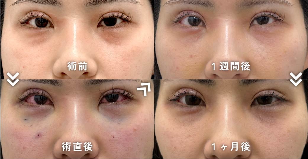 裏ハムラ単体のダウンタイム経過(20代女性)