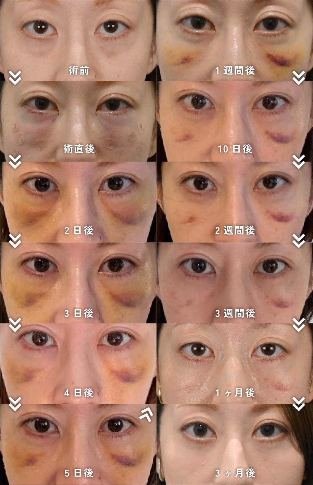 裏ハムラ+脂肪注入のダウンタイム経過(30代女性)