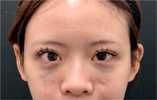 術直後の腫れや内出血