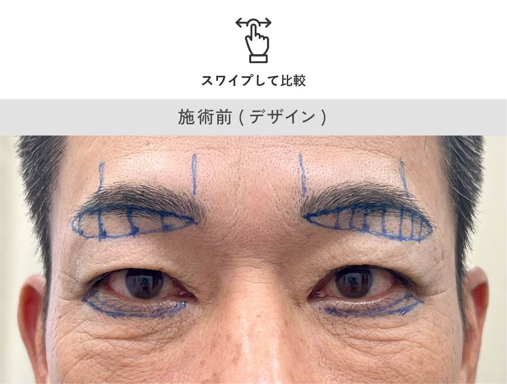 男性の眉下リフト 施術前