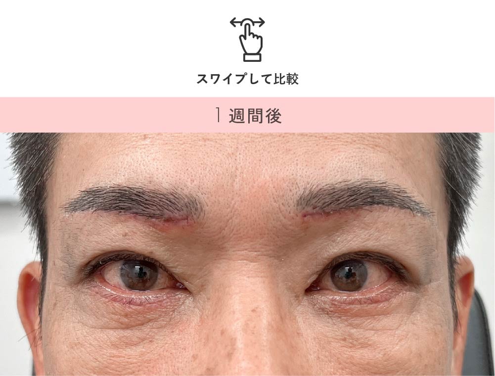 男性の眉下リフト 術後1週間