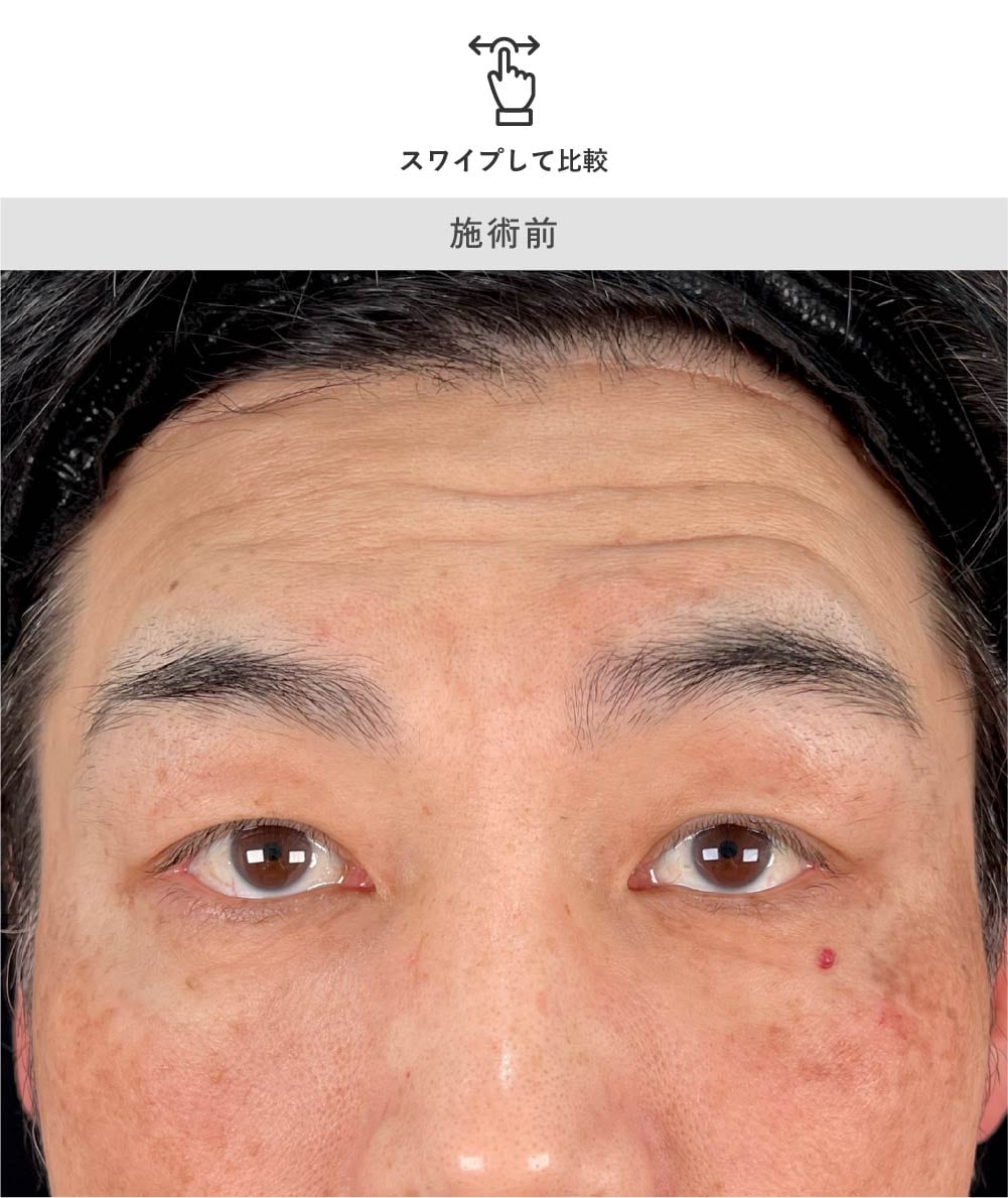 男性の眉下リフト 術前