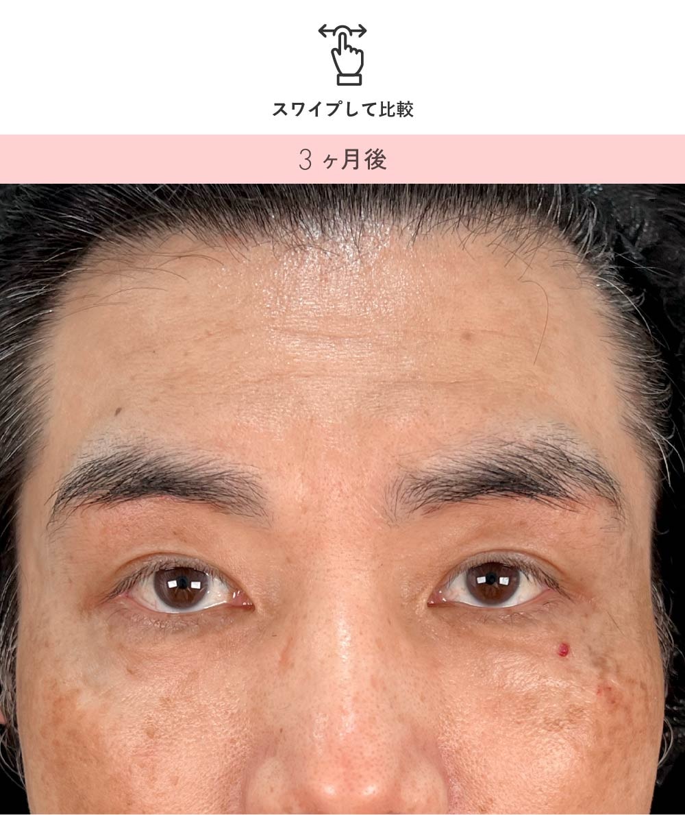 男性の眉下リフト 術後