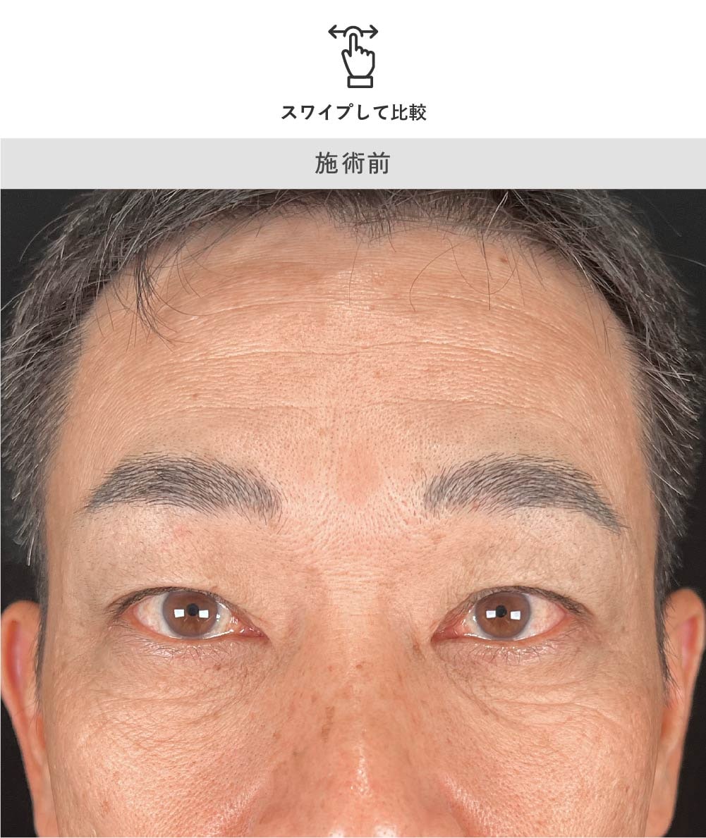 男性の眉下リフト 術前