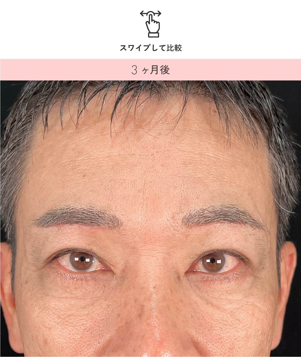 男性の眉下リフト 術後