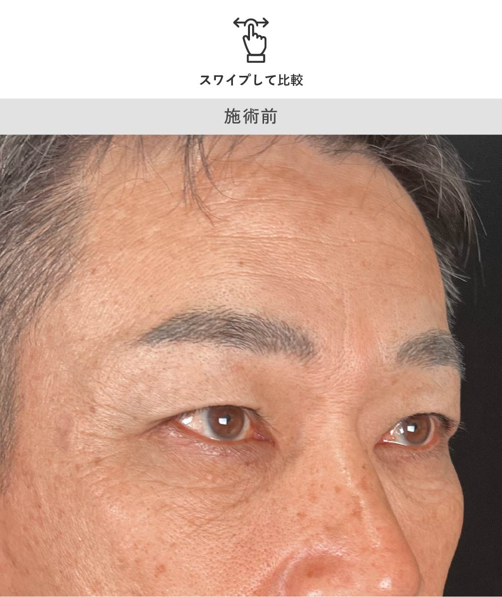 男性の眉下リフト 術前別角度