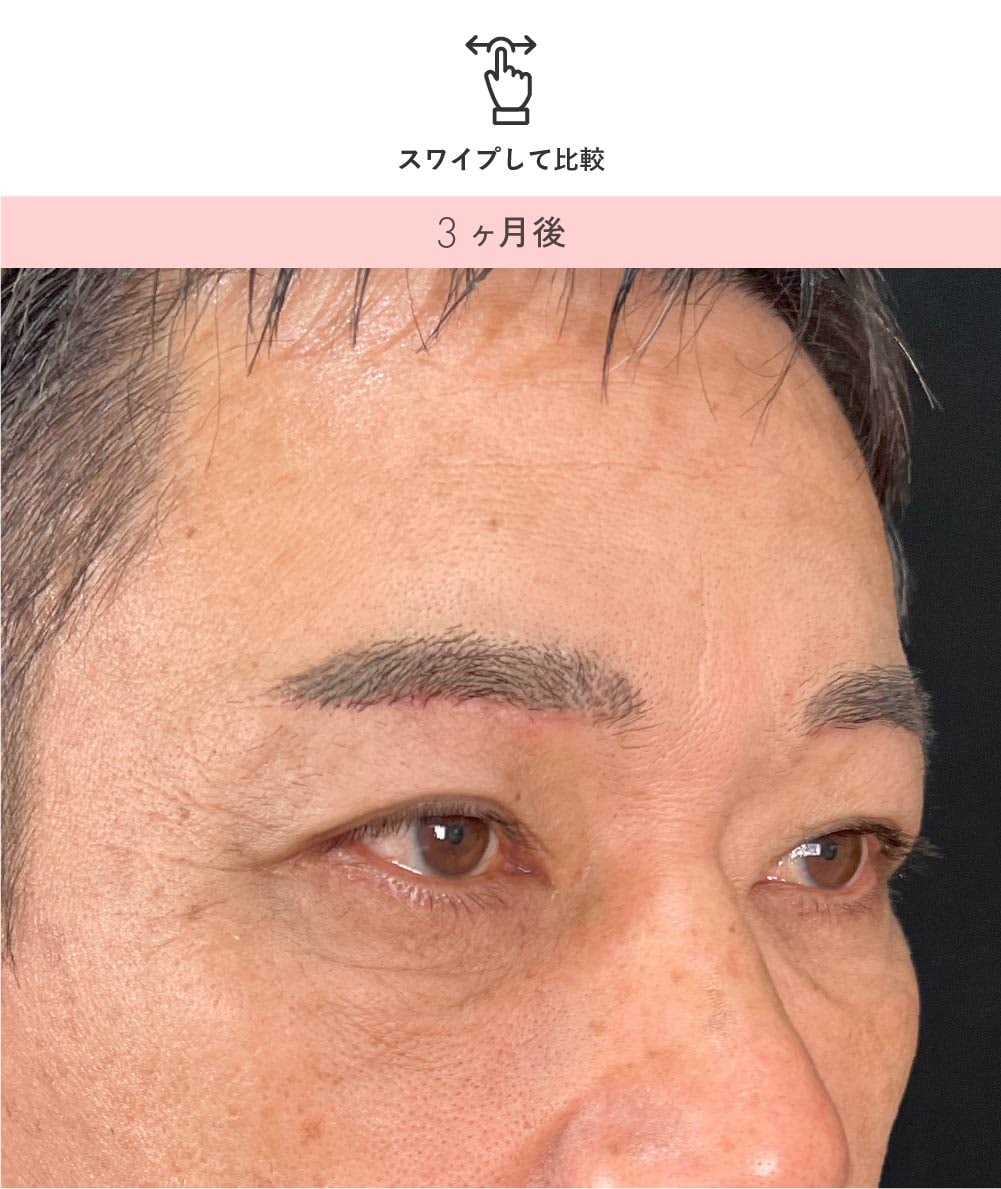 男性の眉下リフト 術後別角度