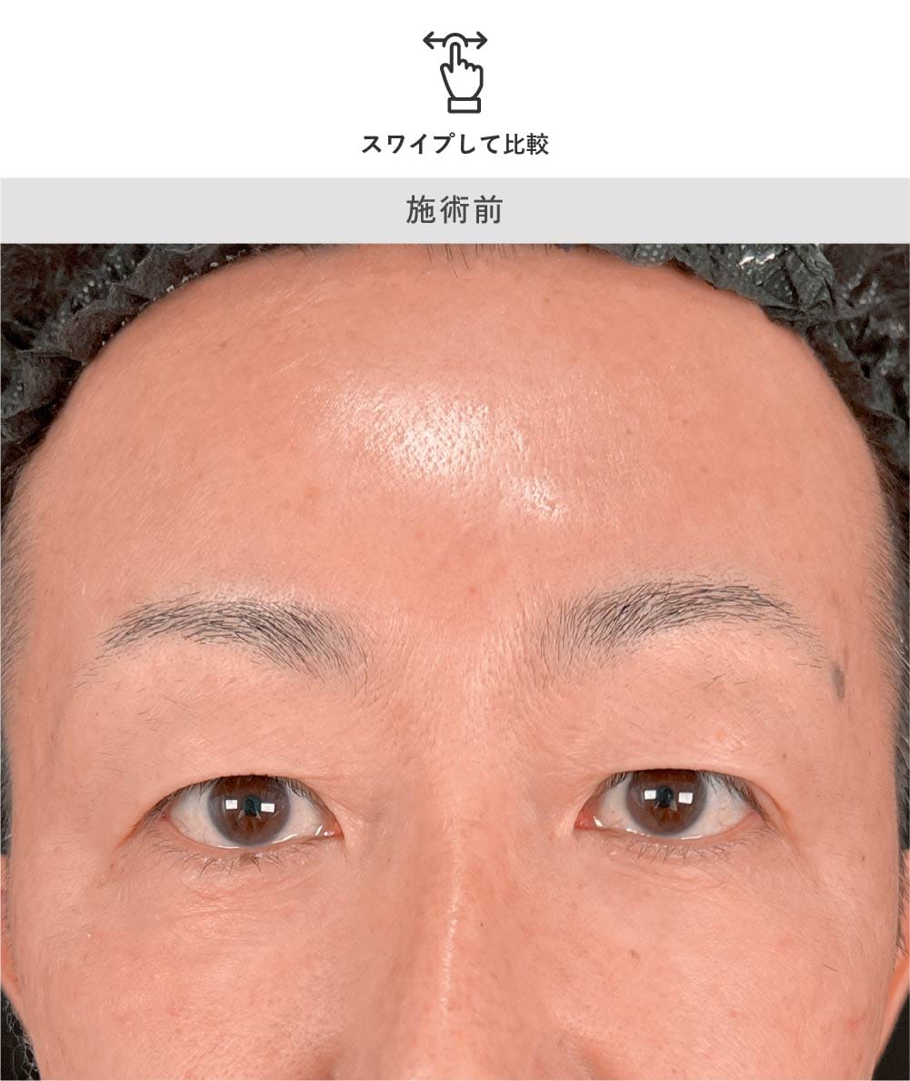 40代男性 眉下リフト 術前