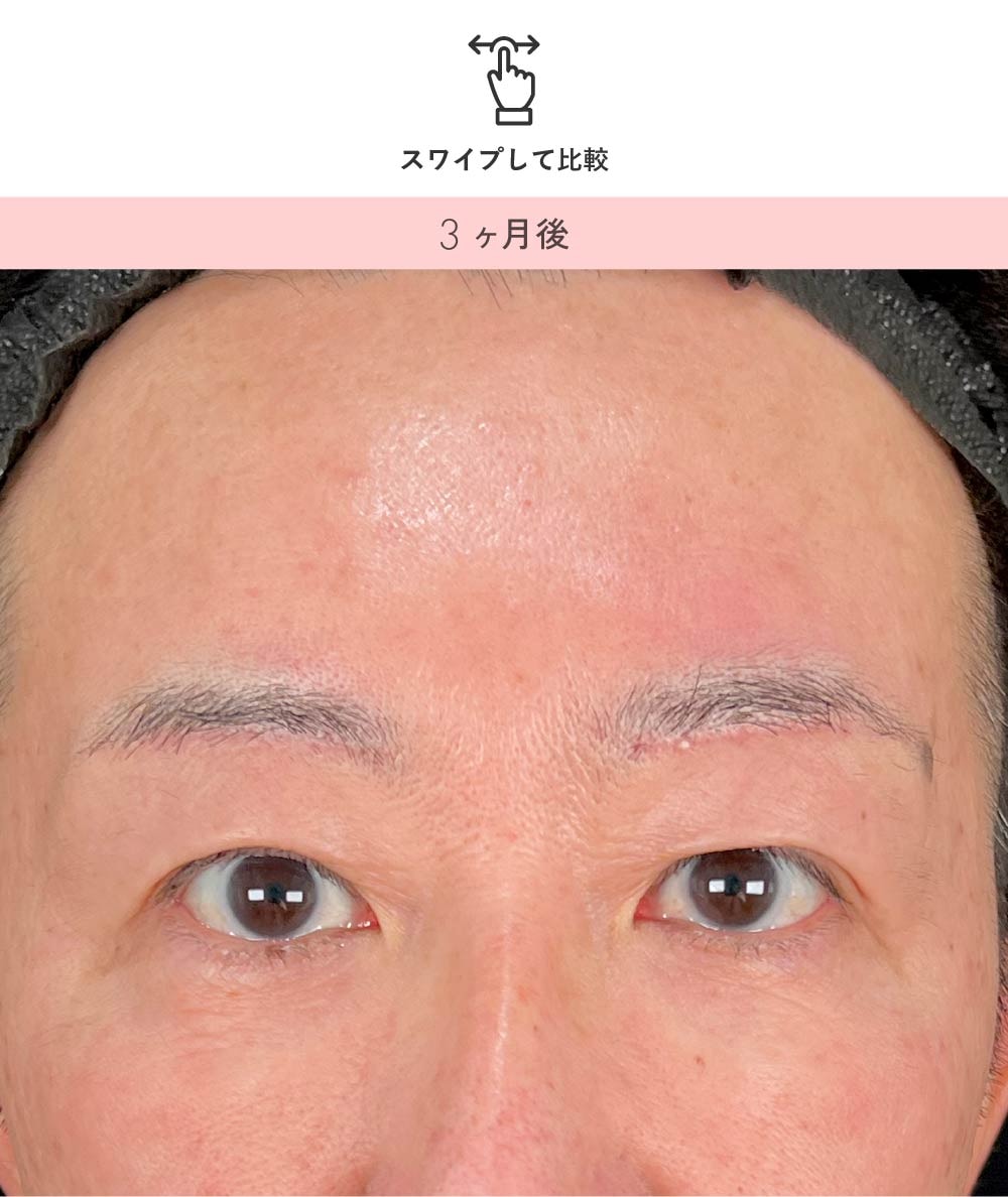 40代男性 眉下リフト 3ヶ月後