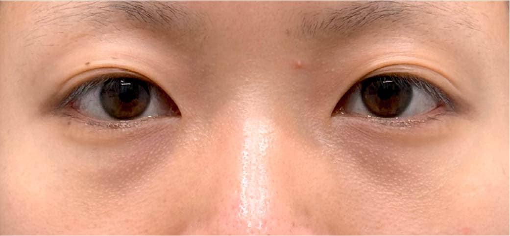 20代女性 裏ハムラ+脂肪注入 術前