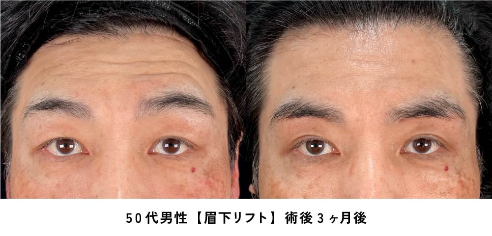 京都 眉下リフト 症例写真1