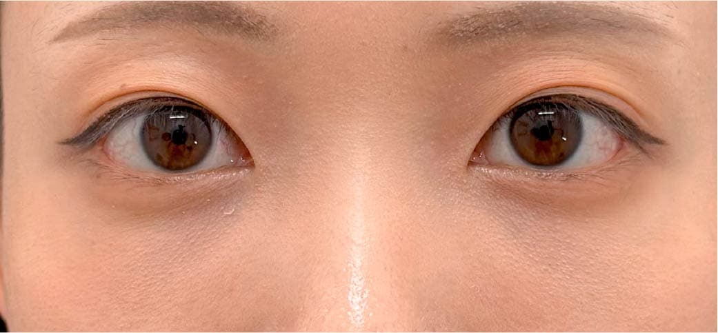 20代女性 裏ハムラ+脂肪注入 1ヶ月後
