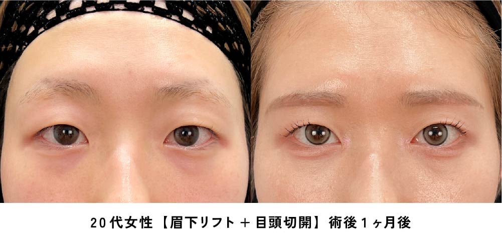 京都 眉下リフト 症例写真2