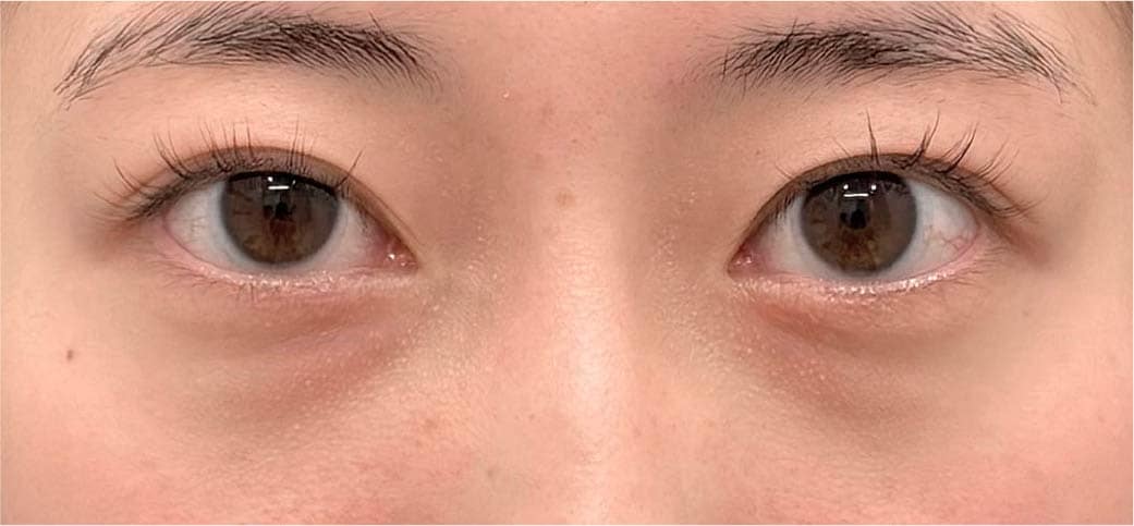 20代女性 裏ハムラ単体 術前