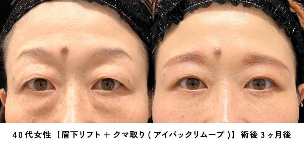 京都 眉下リフト 症例写真3