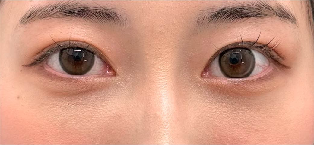 20代女性 裏ハムラ単体 1ヶ月後
