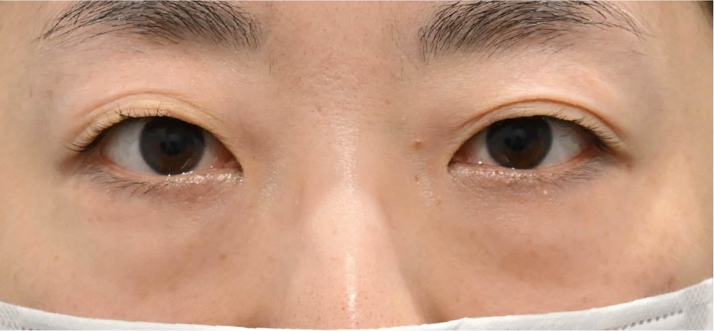 30代女性 裏ハムラ単体 術前