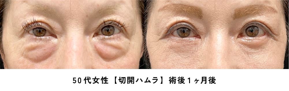 京都 クマ取り 症例写真3