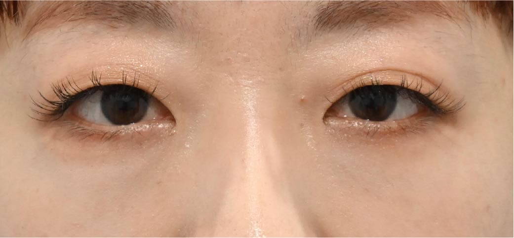 30代女性 裏ハムラ単体 3ヶ月後