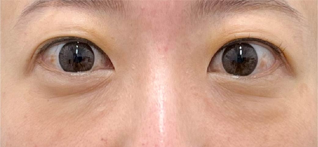 40代女性 裏ハムラ+脂肪注入 術前