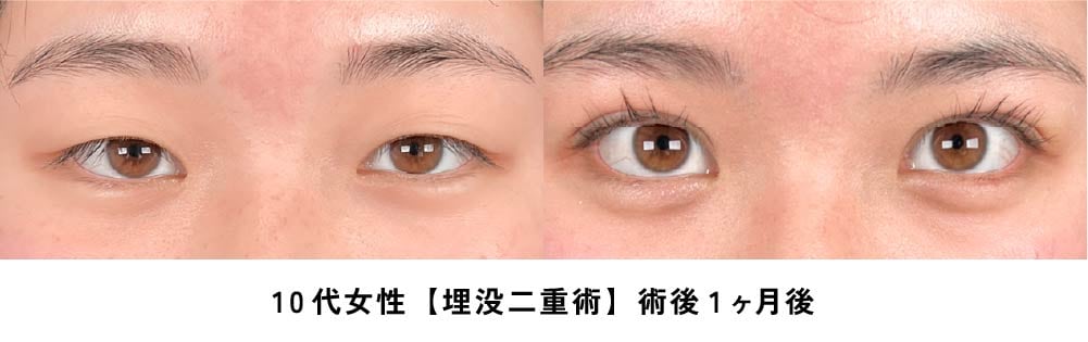 京都 二重 症例写真2
