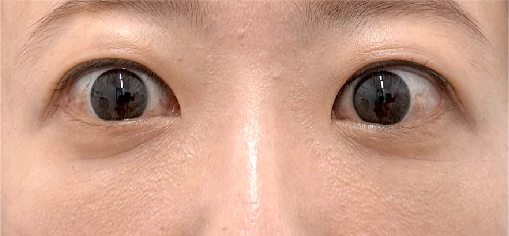 40代女性 裏ハムラ+脂肪注入 1ヶ月後