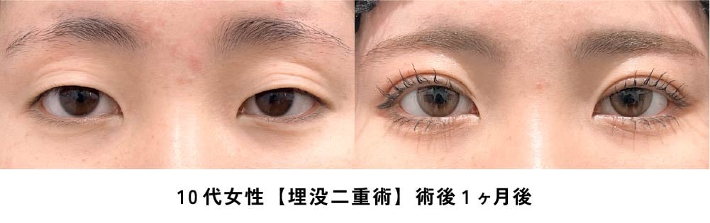 京都 二重 症例写真1