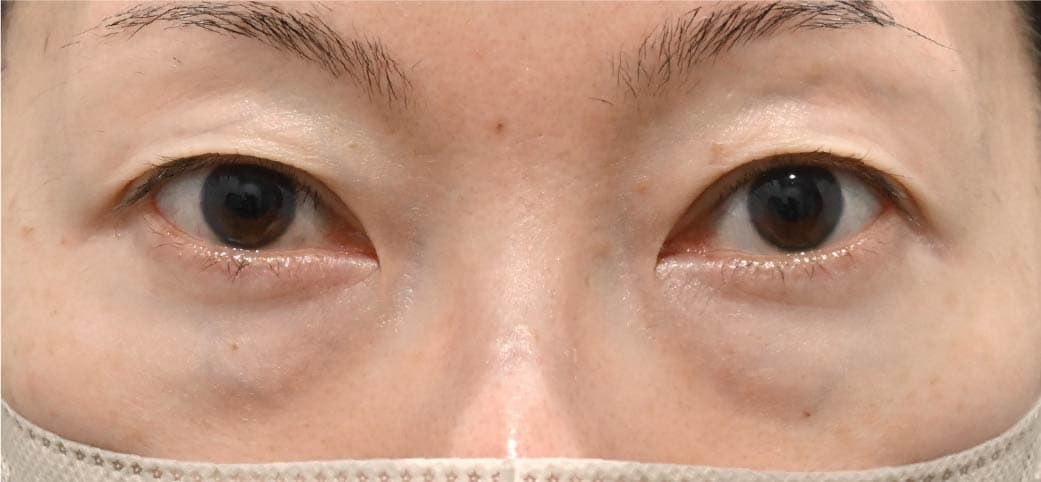 40代女性 裏ハムラ+脂肪注入 術前