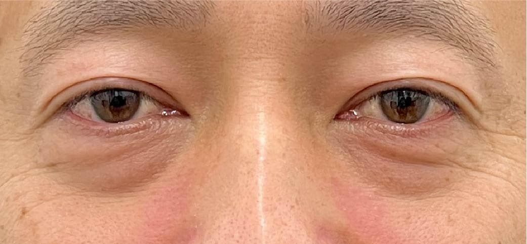 40代男性 裏ハムラ+脂肪注入 術前