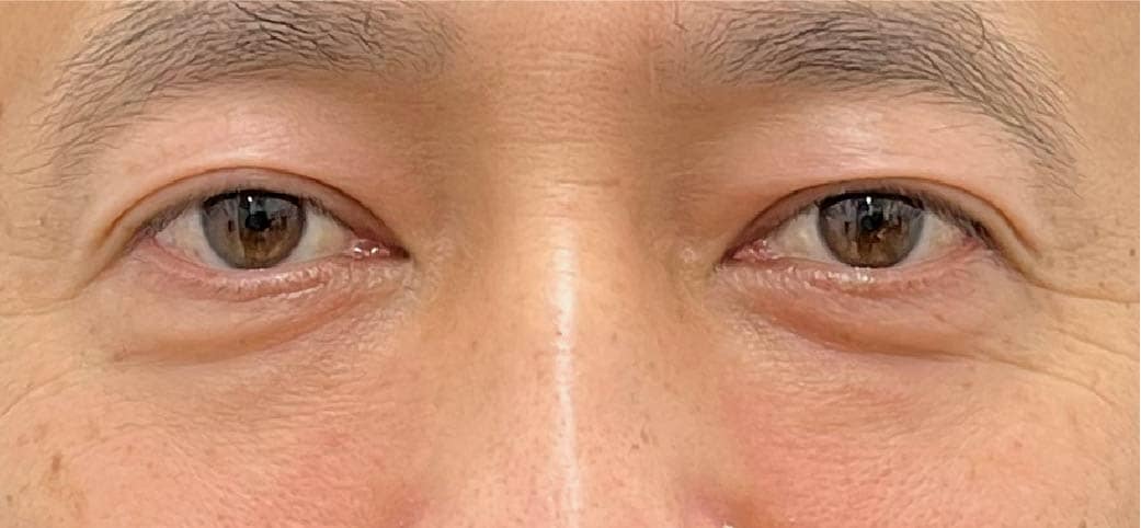 40代男性 裏ハムラ+脂肪注入 3ヶ月後
