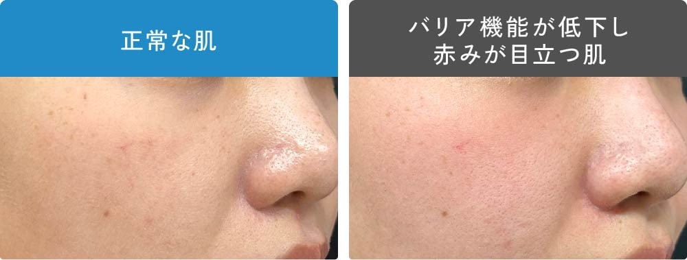 正常な肌とバリア機能が低下し赤みが目立つ肌の比較