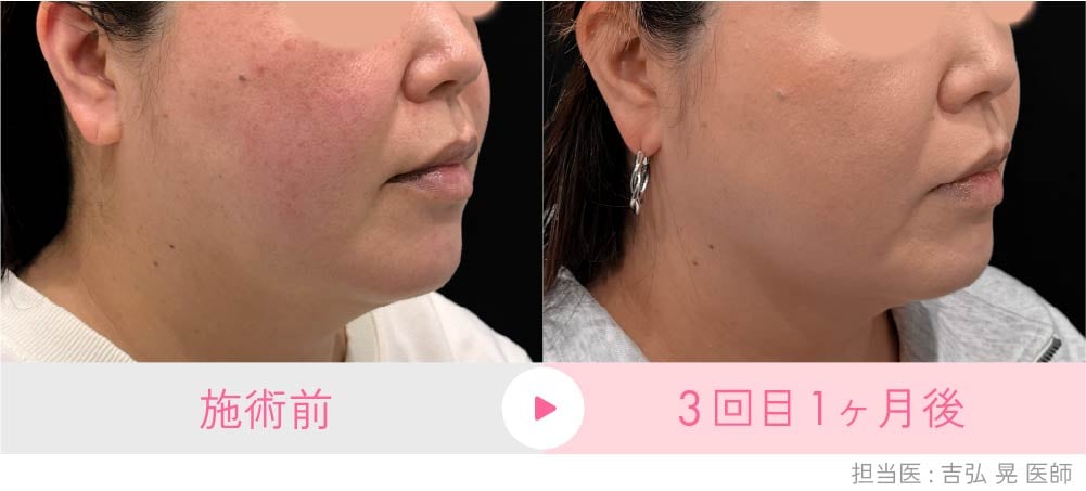 京都院のオンダリフト症例(40代女性):脂肪除去と同時に皮膚がタイトニングされスッキリしたフェイスラインに