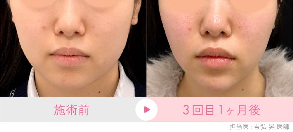 京都院のオンダリフト症例(20代女性):顔の余分な脂肪がスッキリ引き締まり小顔に改善