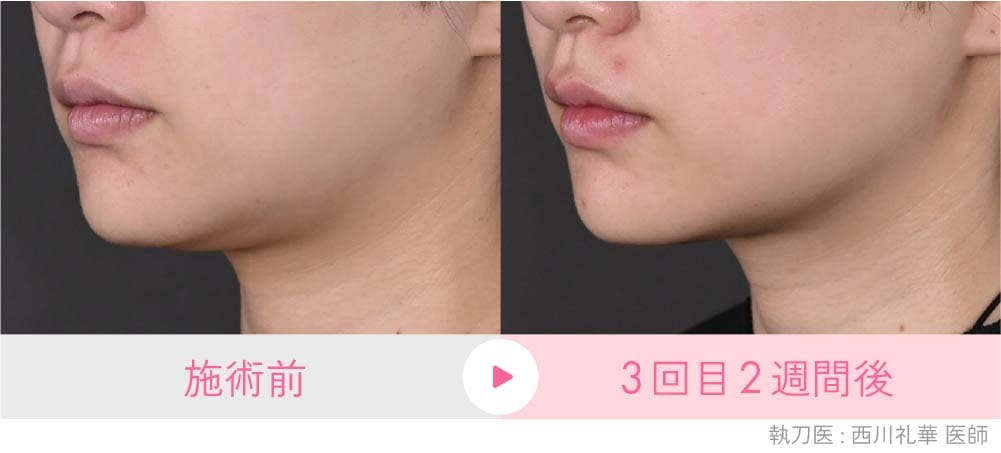 京都院の脂肪溶解リニアHIFU症例:二重アゴが改善しスッキリしたフェイスラインに